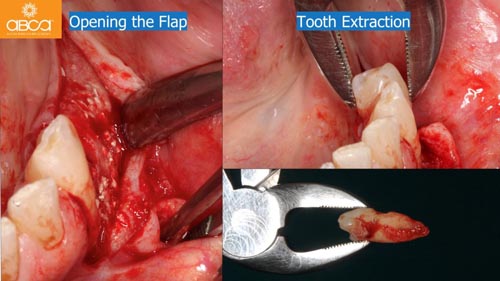 Horizontal Bone and Soft Tissue Augmentation with Augma Bond Apatite