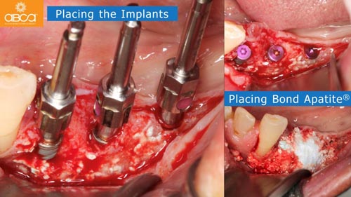 Horizontal Bone and Soft Tissue Augmentation with Augma Bond Apatite