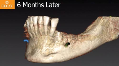 Horizontal Bone and Soft Tissue Augmentation with Augma Bond Apatite