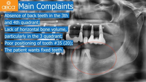 Horizontal Bone and Soft Tissue Augmentation with Augma Bond Apatite