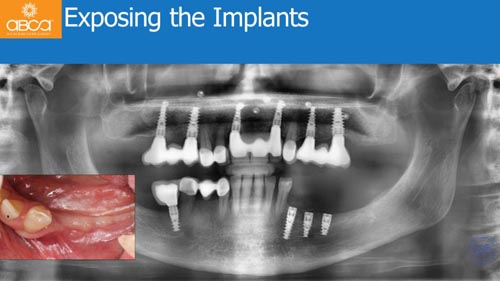 Horizontal Bone and Soft Tissue Augmentation with Augma Bond Apatite