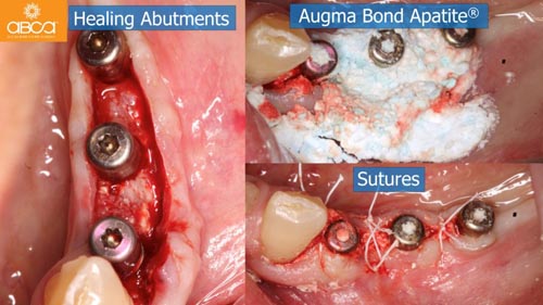 Horizontal Bone and Soft Tissue Augmentation with Augma Bond Apatite