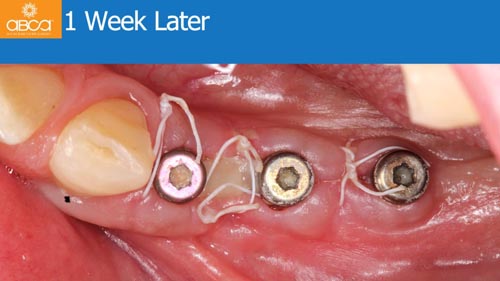 Horizontal Bone and Soft Tissue Augmentation with Augma Bond Apatite