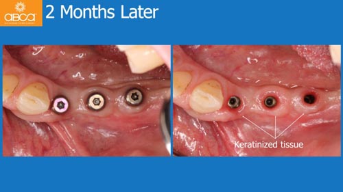 Horizontal Bone and Soft Tissue Augmentation with Augma Bond Apatite