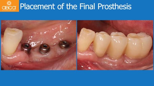 Horizontal Bone and Soft Tissue Augmentation with Augma Bond Apatite