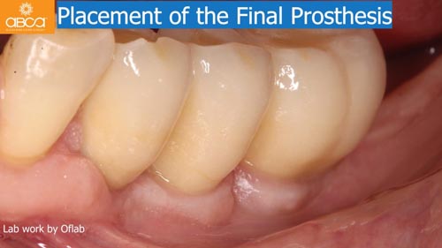 Horizontal Bone and Soft Tissue Augmentation with Augma Bond Apatite