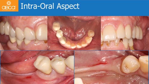 Horizontal Bone and Soft Tissue Augmentation with Augma Bond Apatite