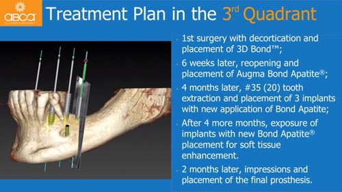 Horizontal Bone and Soft Tissue Augmentation with Augma Bond Apatite