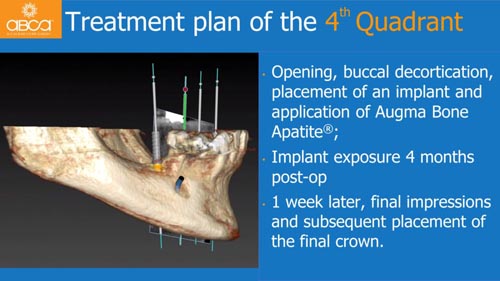 Horizontal Bone and Soft Tissue Augmentation with Augma Bond Apatite