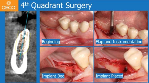 Horizontal Bone and Soft Tissue Augmentation with Augma Bond Apatite