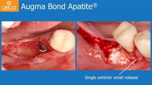 Horizontal Bone and Soft Tissue Augmentation with Augma Bond Apatite