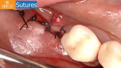 Horizontal Bone and Soft Tissue Augmentation with Augma Bond Apatite