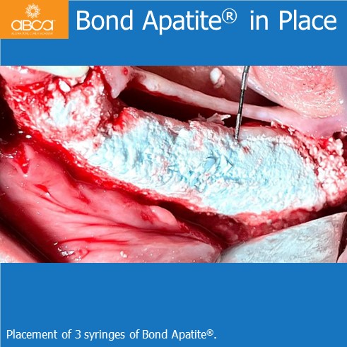 Lateral Augmentation in Mandibular Atrophy