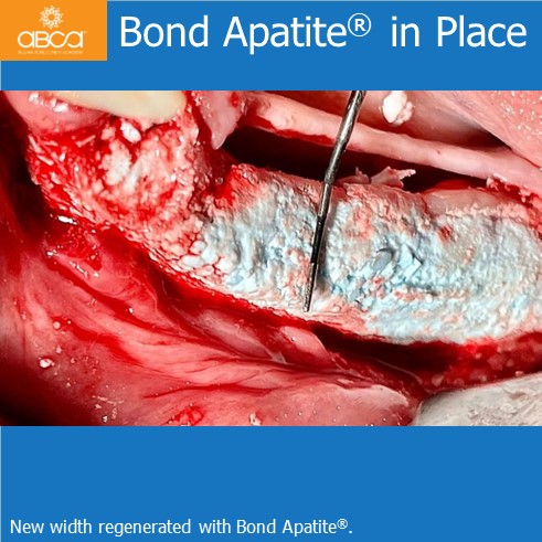 Lateral Augmentation in Mandibular Atrophy