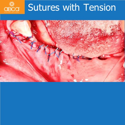 Lateral Augmentation in Mandibular Atrophy