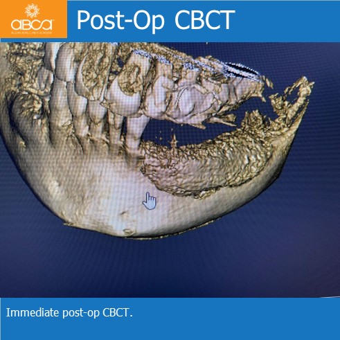 Lateral Augmentation in Mandibular Atrophy