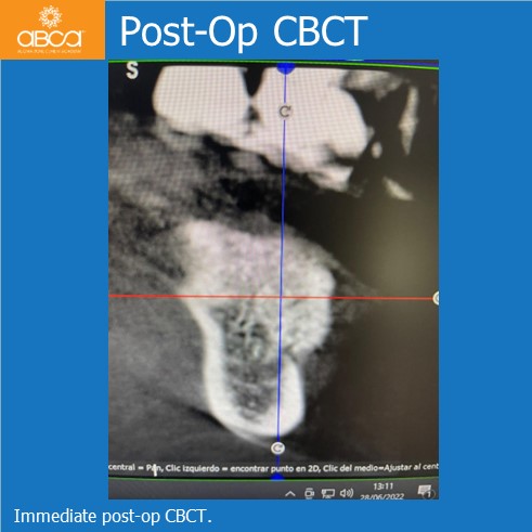 Lateral Augmentation in Mandibular Atrophy