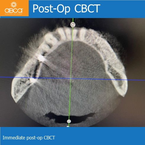 Lateral Augmentation in Mandibular Atrophy