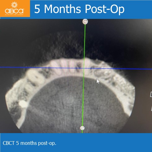 Lateral Augmentation in Mandibular Atrophy