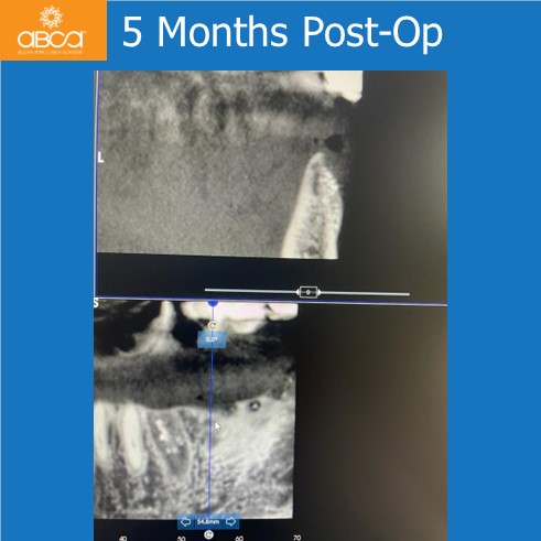 Lateral Augmentation in Mandibular Atrophy