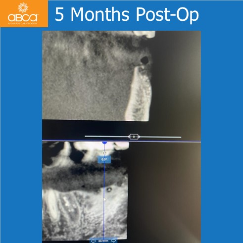 Lateral Augmentation in Mandibular Atrophy