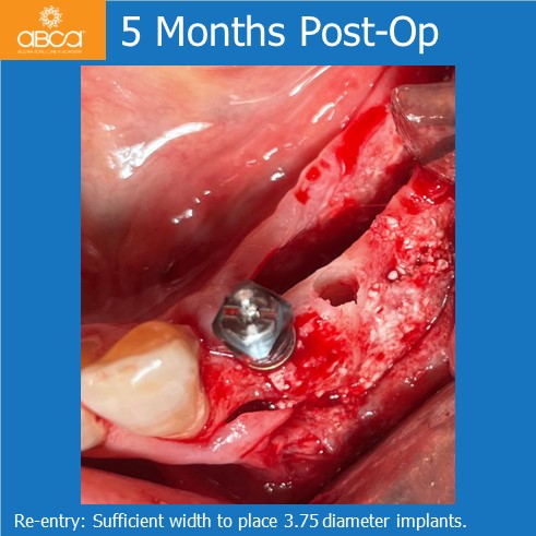 Lateral Augmentation in Mandibular Atrophy