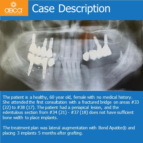 Lateral Augmentation in Mandibular Atrophy