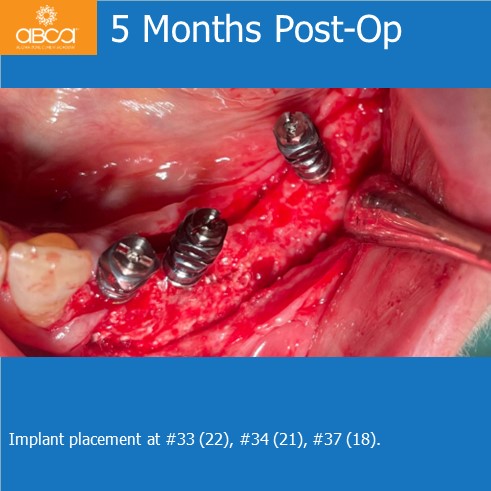 Lateral Augmentation in Mandibular Atrophy