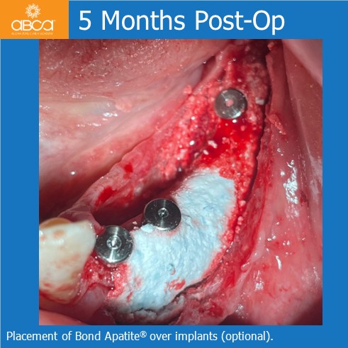 Lateral Augmentation in Mandibular Atrophy