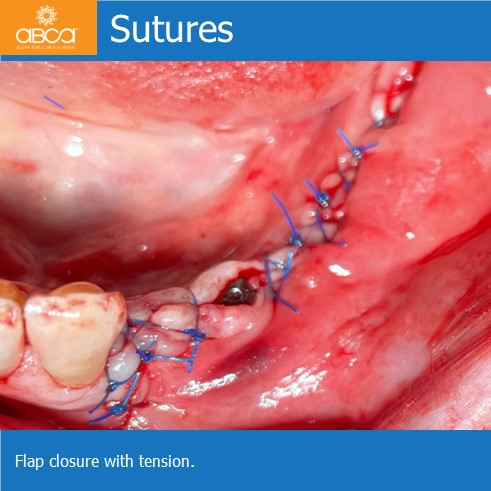 Lateral Augmentation in Mandibular Atrophy