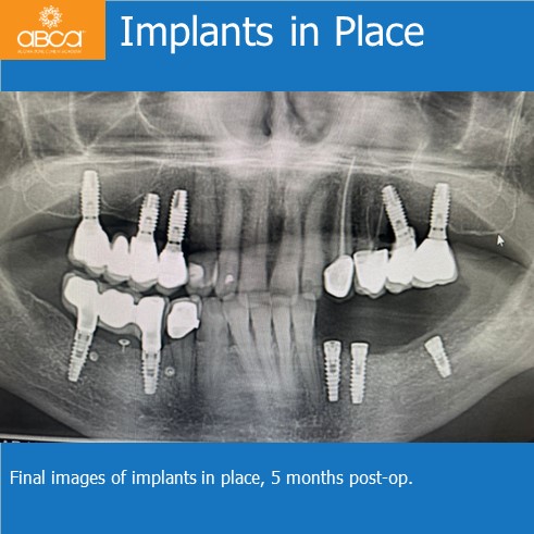 Lateral Augmentation in Mandibular Atrophy