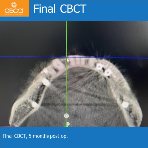 Lateral Augmentation in Mandibular Atrophy