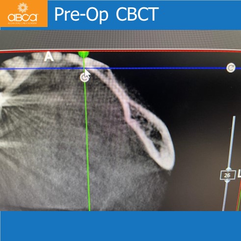 Lateral Augmentation in Mandibular Atrophy