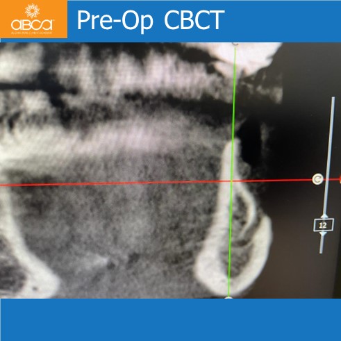 Lateral Augmentation in Mandibular Atrophy