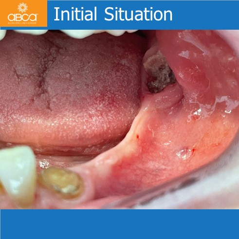 Lateral Augmentation in Mandibular Atrophy