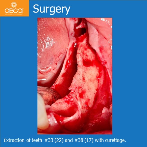 Lateral Augmentation in Mandibular Atrophy