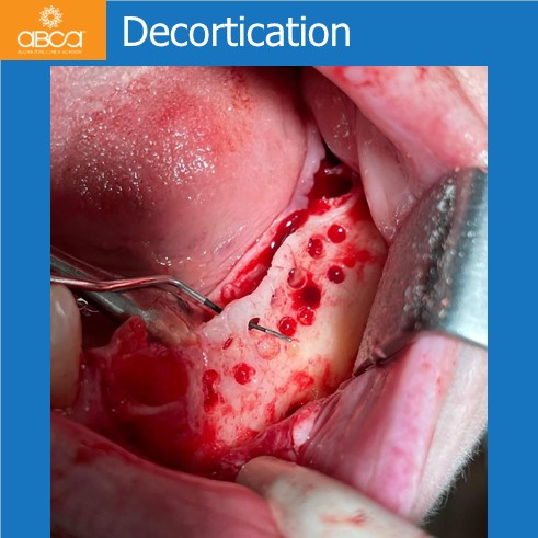 Lateral Augmentation in Mandibular Atrophy