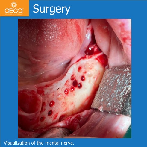 Lateral Augmentation in Mandibular Atrophy