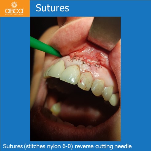 Little Cyst #21 (9)