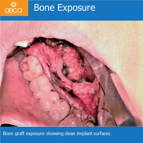 Expansive Lesion of the Right Maxilla Extraction and Immediate Reconstruction with Augma Bond ApatiteŽ