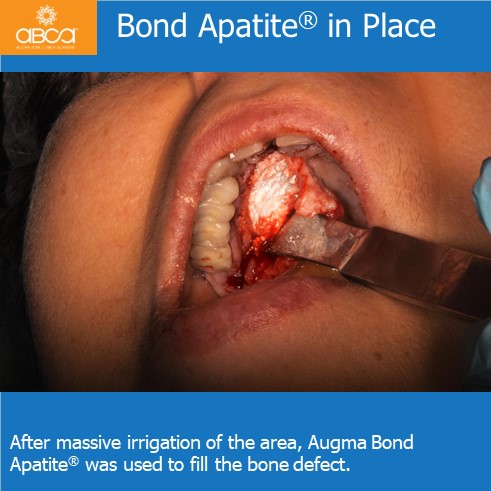 Expansive Lesion of the Right Maxilla Extraction and Immediate Reconstruction with Augma Bond ApatiteŽ