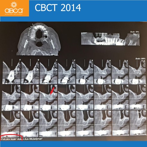 Expansive Lesion of the Right Maxilla Extraction and Immediate Reconstruction with Augma Bond ApatiteŽ
