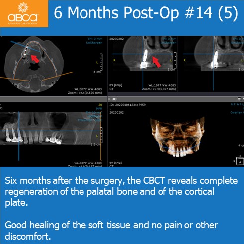 Expansive Lesion of the Right Maxilla Extraction and Immediate Reconstruction with Augma Bond ApatiteŽ