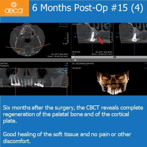 Expansive Lesion of the Right Maxilla Extraction and Immediate Reconstruction with Augma Bond ApatiteŽ