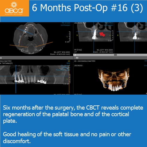 Expansive Lesion of the Right Maxilla Extraction and Immediate Reconstruction with Augma Bond ApatiteŽ