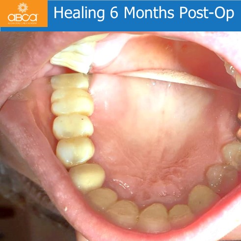 Expansive Lesion of the Right Maxilla Extraction and Immediate Reconstruction with Augma Bond ApatiteŽ