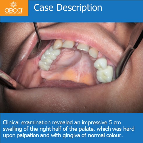 Expansive Lesion of the Right Maxilla Extraction and Immediate Reconstruction with Augma Bond ApatiteŽ