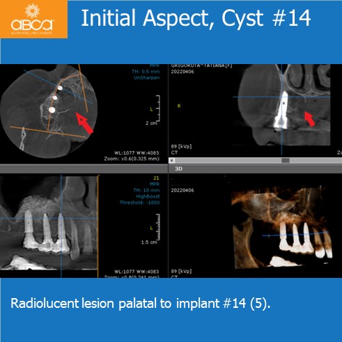Expansive Lesion of the Right Maxilla Extraction and Immediate Reconstruction with Augma Bond ApatiteŽ