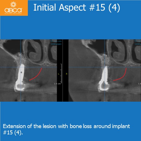 Expansive Lesion of the Right Maxilla Extraction and Immediate Reconstruction with Augma Bond ApatiteŽ