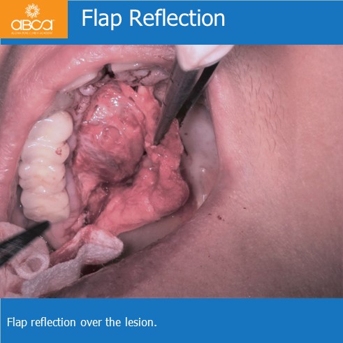 Expansive Lesion of the Right Maxilla Extraction and Immediate Reconstruction with Augma Bond ApatiteŽ